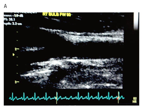 Fig A:  An ultrasound image detects carotid artery thickening in a teen with type 1 diabetes. A study published in Diabetes Care reports that elevated BMIz scores were the only one of several cardiovascular risk factors that were associated with carotid artery thickening.